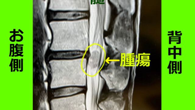 MRI初見