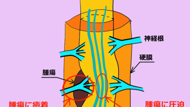 激痛の原因