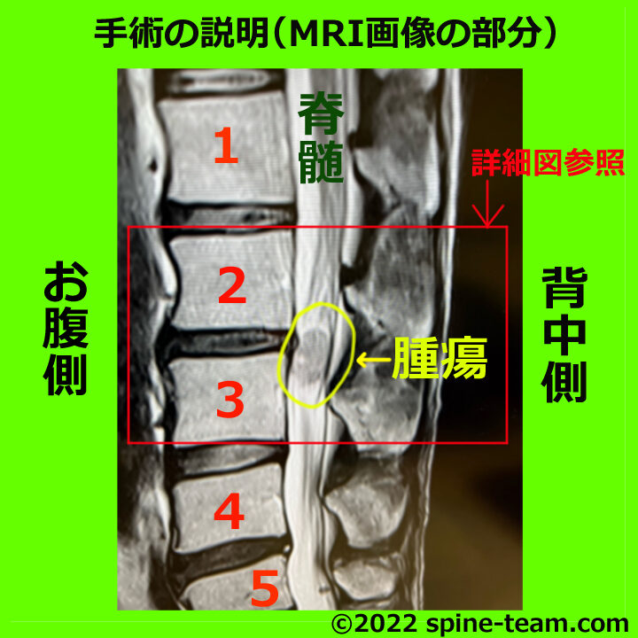 手術の説明（MRI画像の部分）