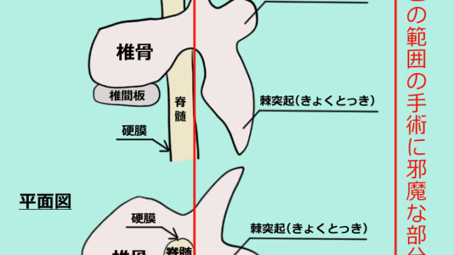 手術の説明（椎骨を削る範囲）